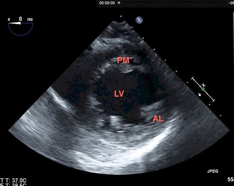 lv echocardiography preload